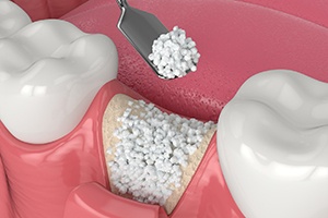 an illustration of a dental bone graft