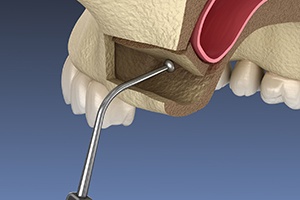 an illustration of a sinus lift procedure
