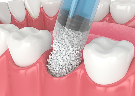 a 3D illustration of a dental bone graft
