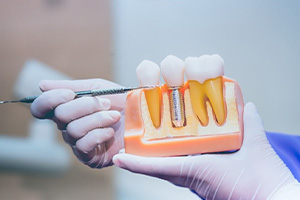 Dentist pointing out the part of a dental implant on a model