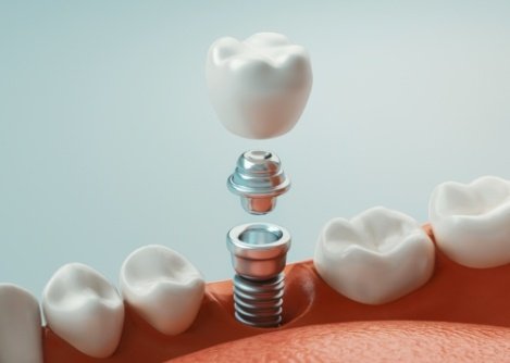 Animated dental implant with abutment and crown being placed in the lower jaw