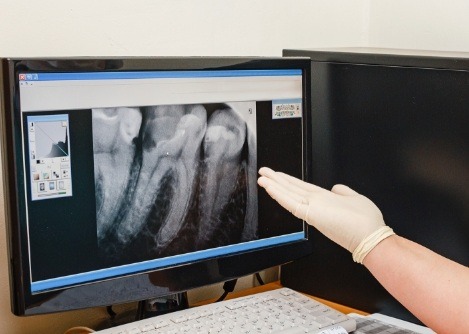 Gloved hand gesturing toward computer screen showing digital dental x rays of teeth