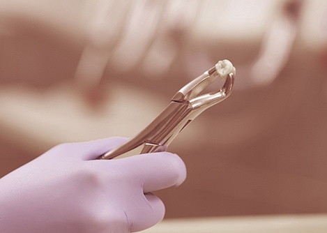 Dental forceps holding a tooth after tooth extraction in Worcester