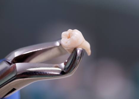 Dental forceps holding an extracted tooth