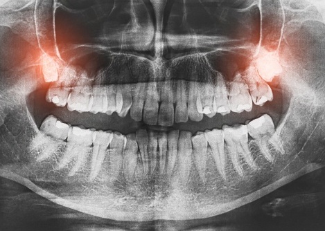 Dental x ray with impacted wisdom teeth highlighted red