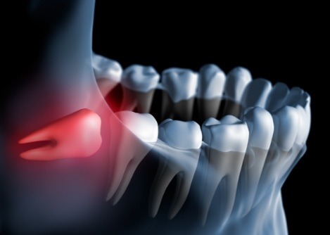 Animated impacted wisdom tooth pressing against other teeth