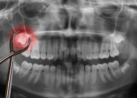 Dental forceps over highlighted red wisdom tooth in dental x ray