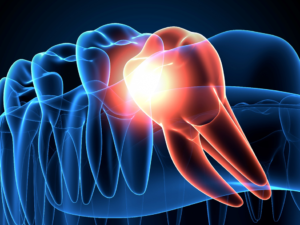 a graphic render of an impacted wisdom tooth