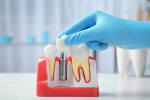 a model of dental implants