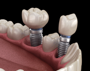 a close-up model of dental implants